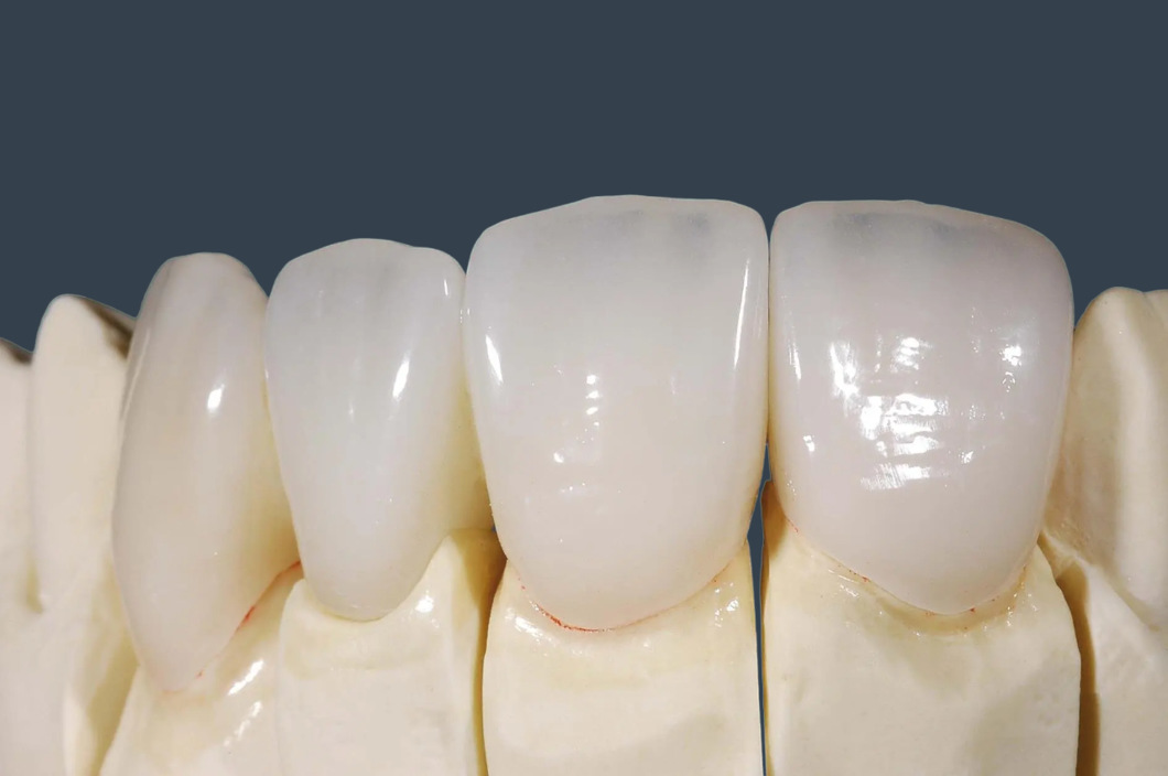 Фото керамических коронок E-max на передние зубы