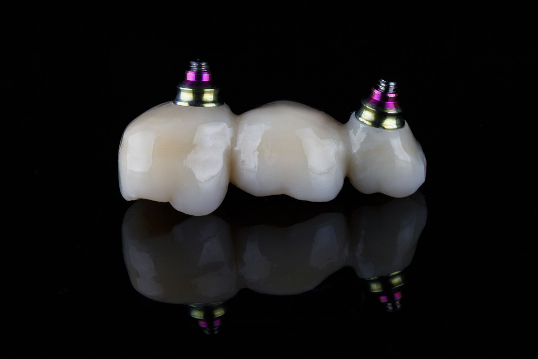 Фото зубного моста на имплантах