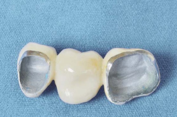 Коронки для зубов из металлокерамики