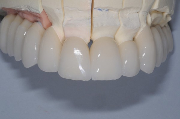 Безметалловые коронки для зубов