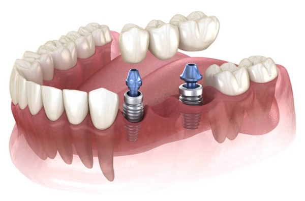Зубной мост на имплантах